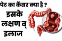 पेट के कैंसर से बचाव