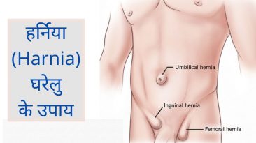 हर्निया के कारण और उपाय